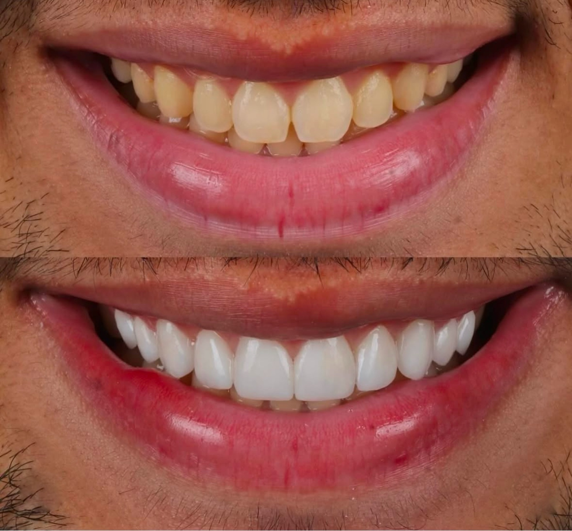 Antes e depois — paciente masculino