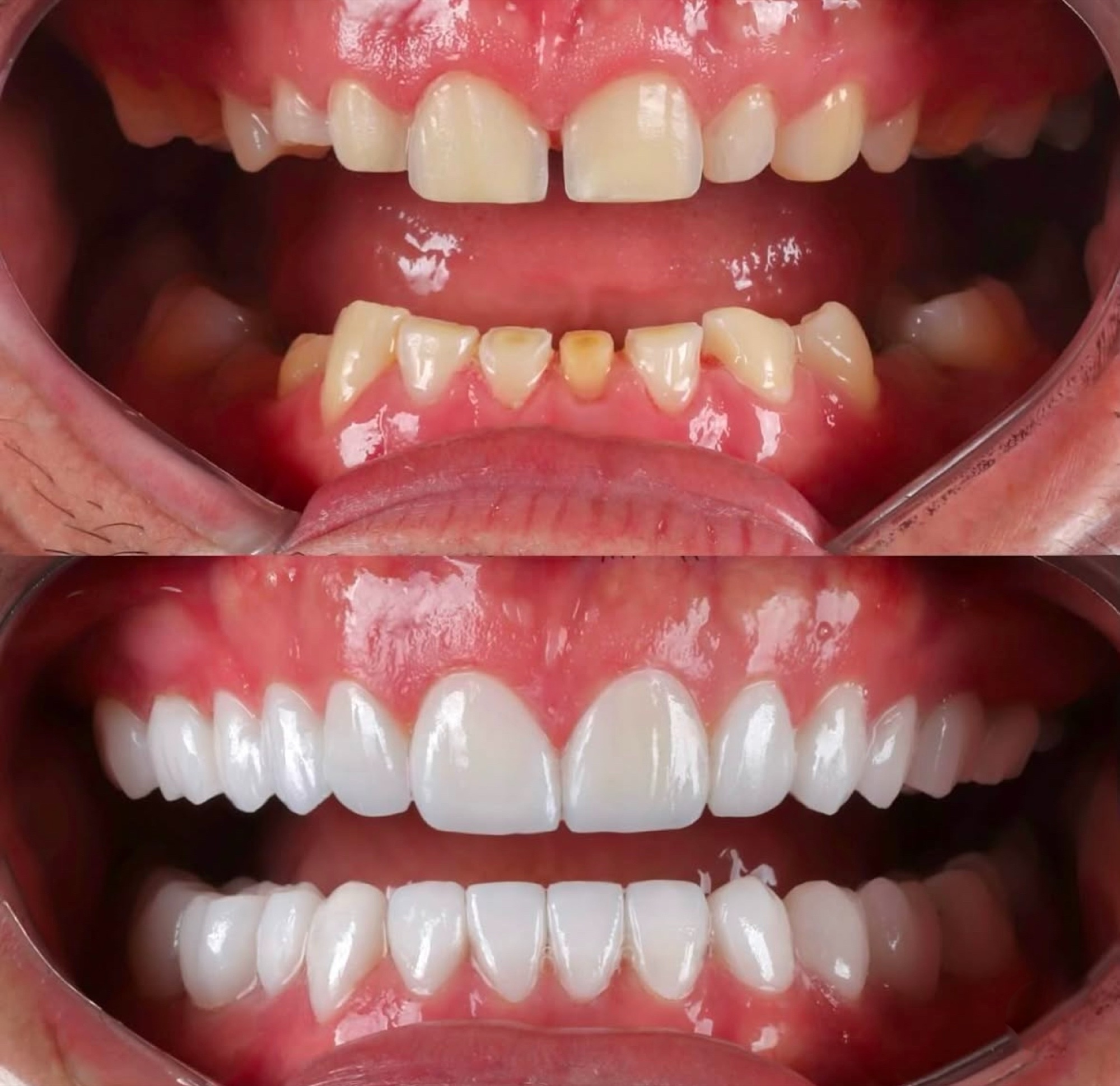 Antes e depois — fechamento de diastema