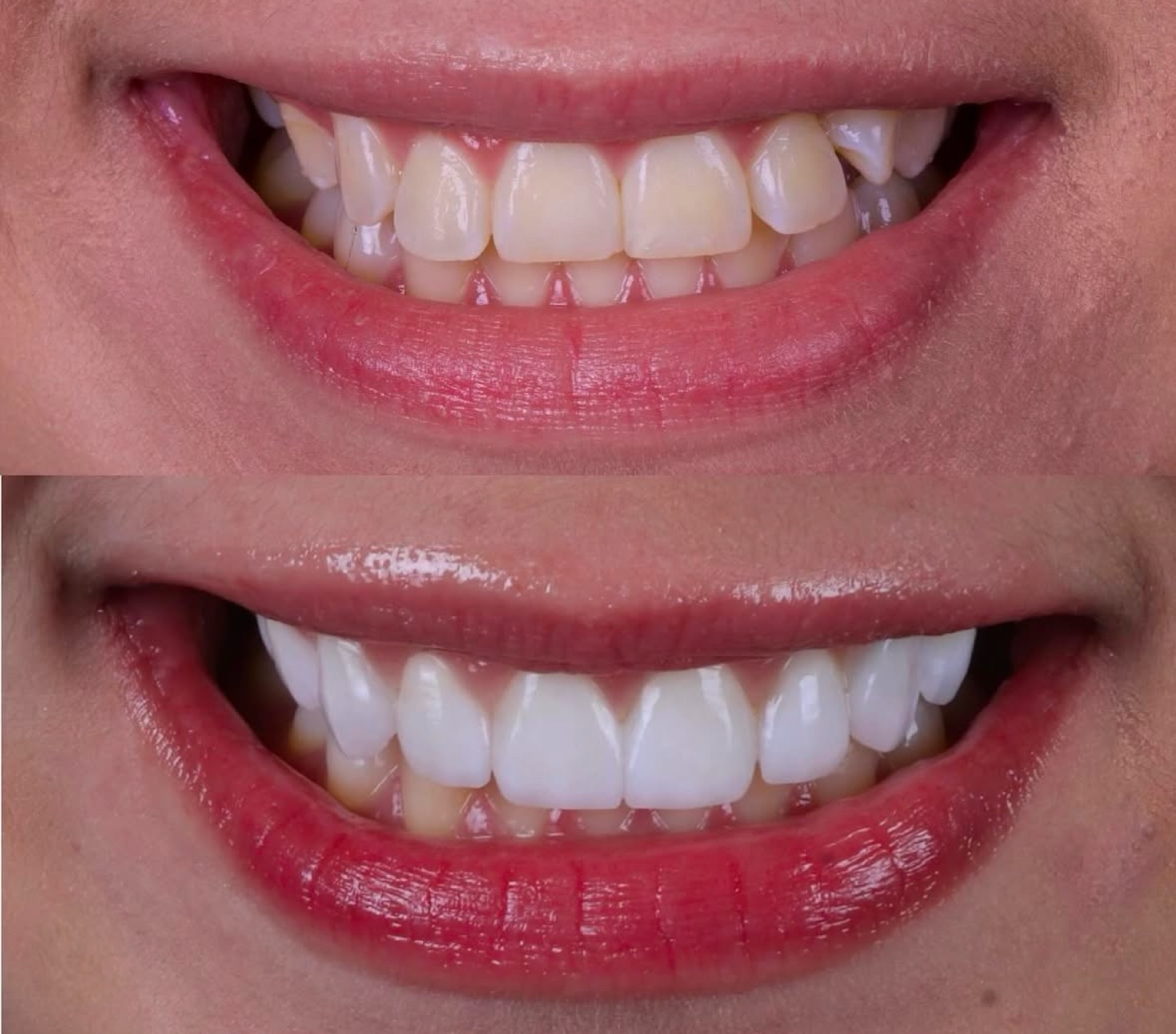 Antes e depois — paciente feminina