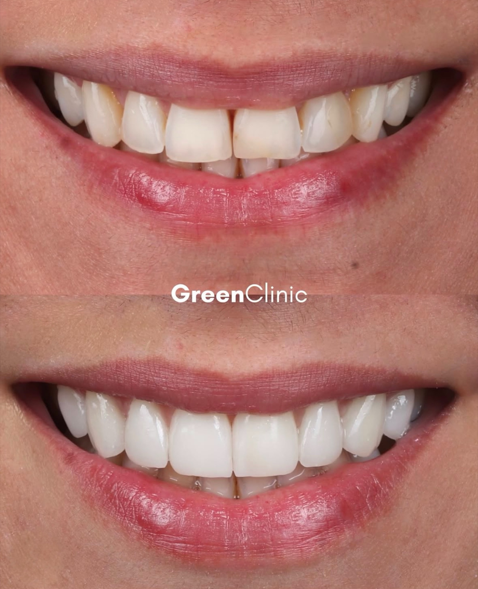 Antes e depois — lentes em porcelana