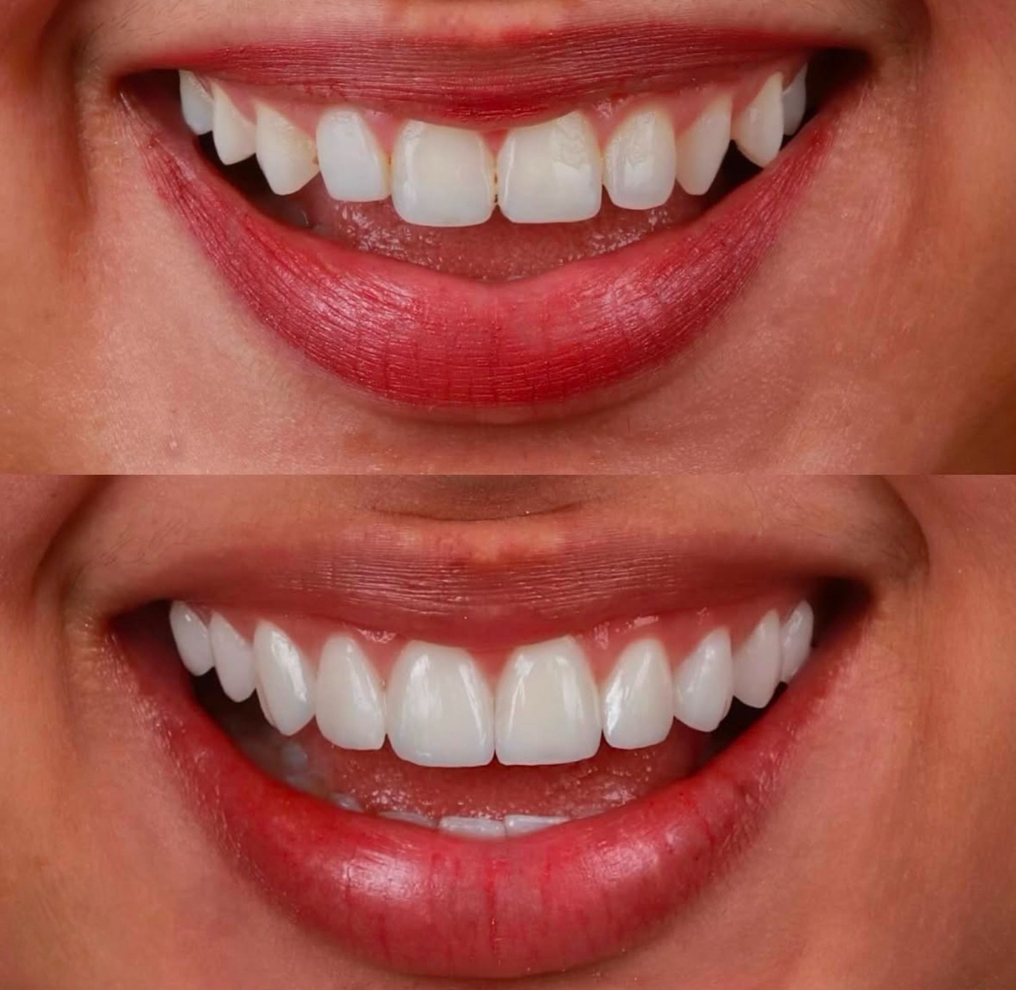 Antes e depois — clareamento