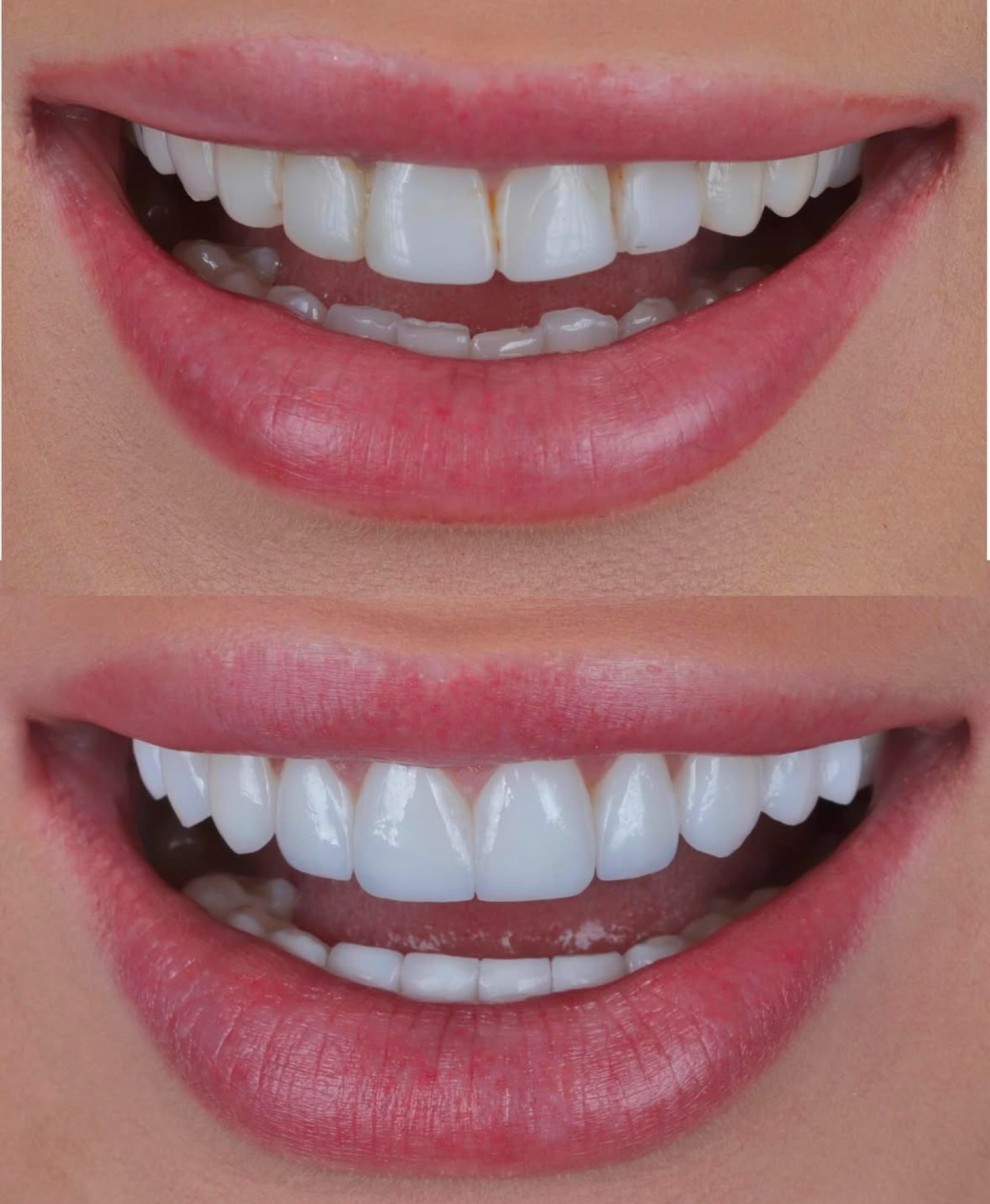 Antes e depois — lentes superiores