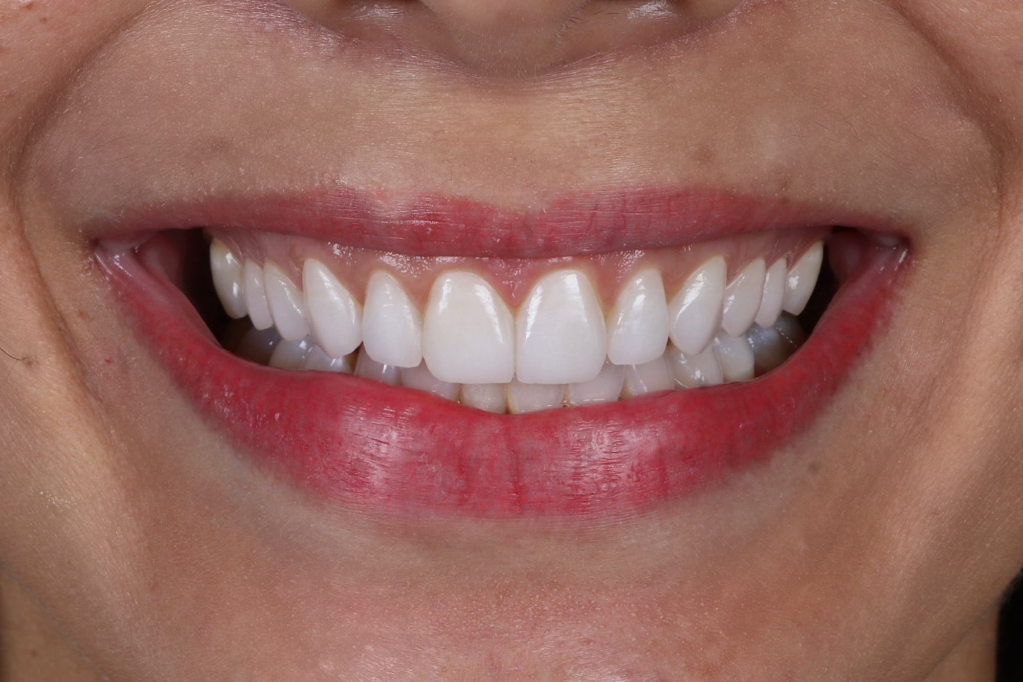 Resultado em facetas